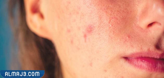 أسباب حبوب الوجه الصغيرة