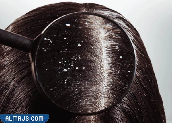 أسباب قشرة الشعر