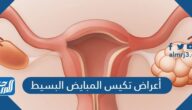 أعراض تكيس المبايض البسيط