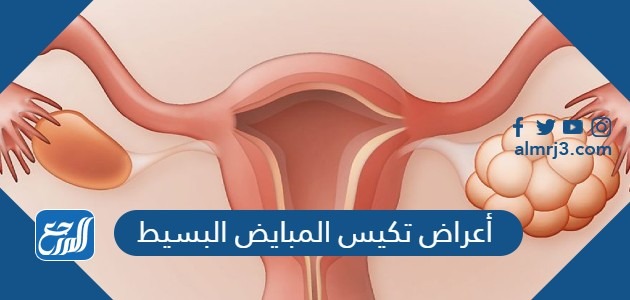 أعراض تكيس المبايض البسيط