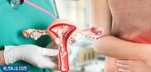 أعراض ميلان الرحم