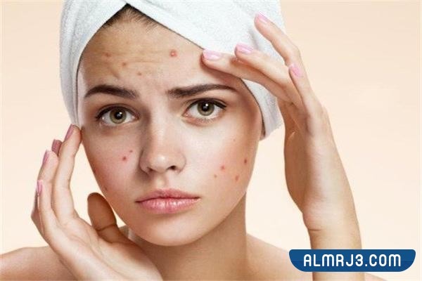 إجراءات طبية للتخلص من حبوب الوجه