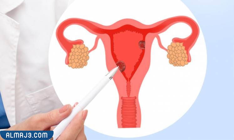 المضاعفات الناتجة عن هبوط الرحم