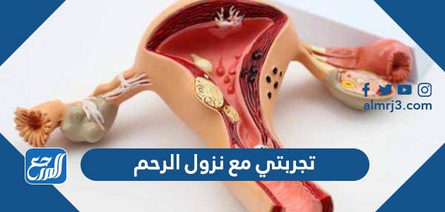 تجربتي مع نزول الرحم