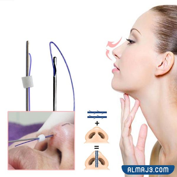 تجميل الأنف بالخيوط