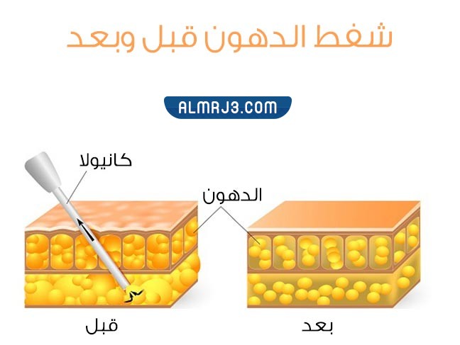 تقنيات شفط الدهون في مستشفى الحبيب