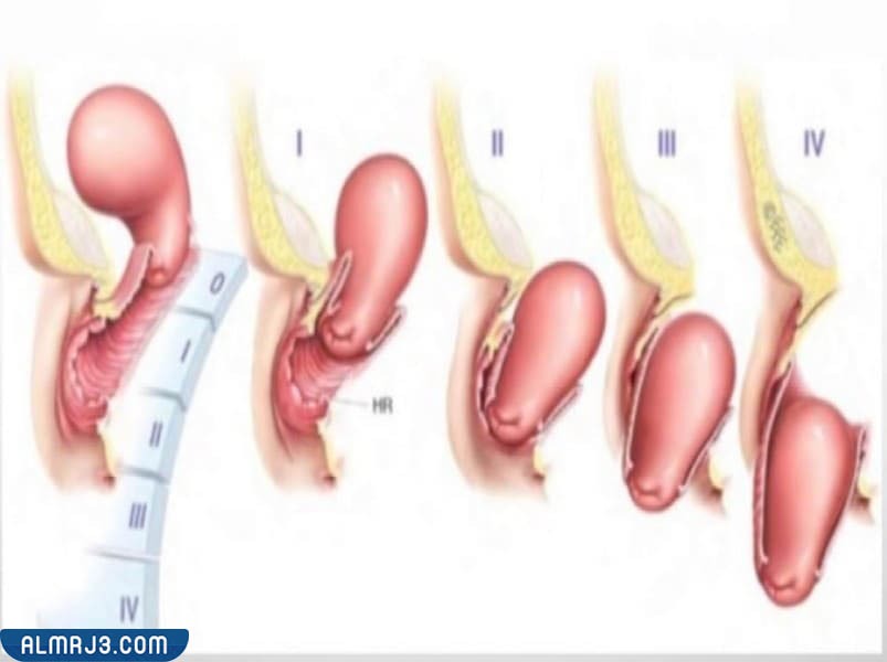 درجات هبوط الرحم