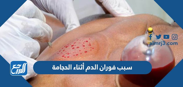 سبب فوران الدم أثناء الحجامة