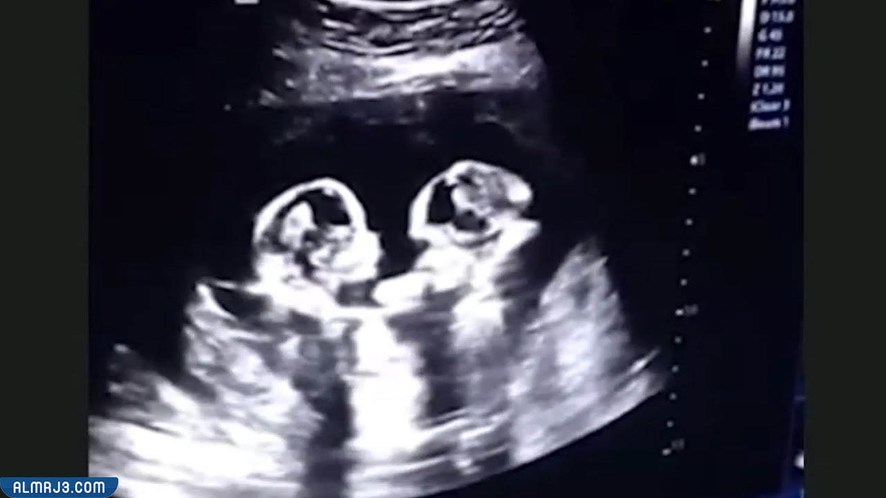 Reasons Why Twins and Multiples Are Born Early 