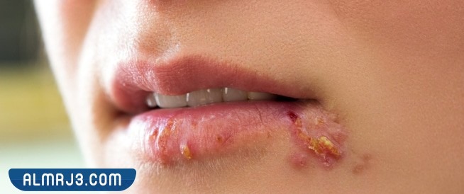 طرق الوقاية من حبوب الشفايف