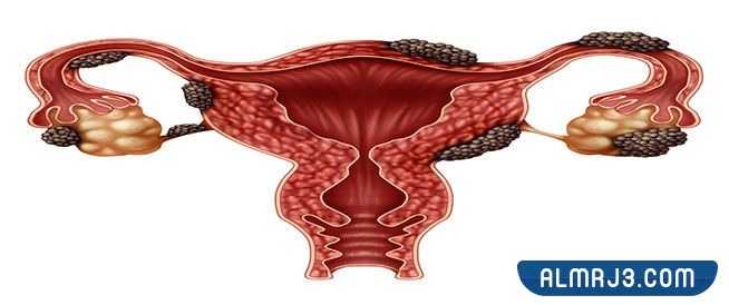 طرق علاج تكيس المبايض للمتزوجات