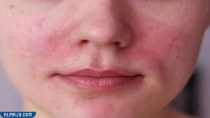 علاج الخجل واحمرار الوجه