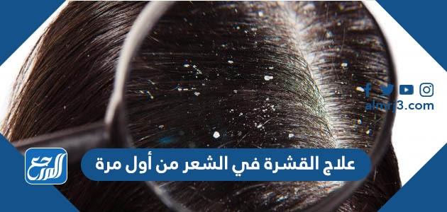 علاج القشرة في الشعر من أول مرة