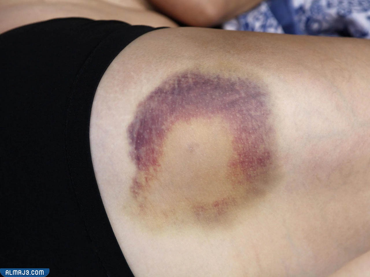 أعراض نقص الصفائح الدموية