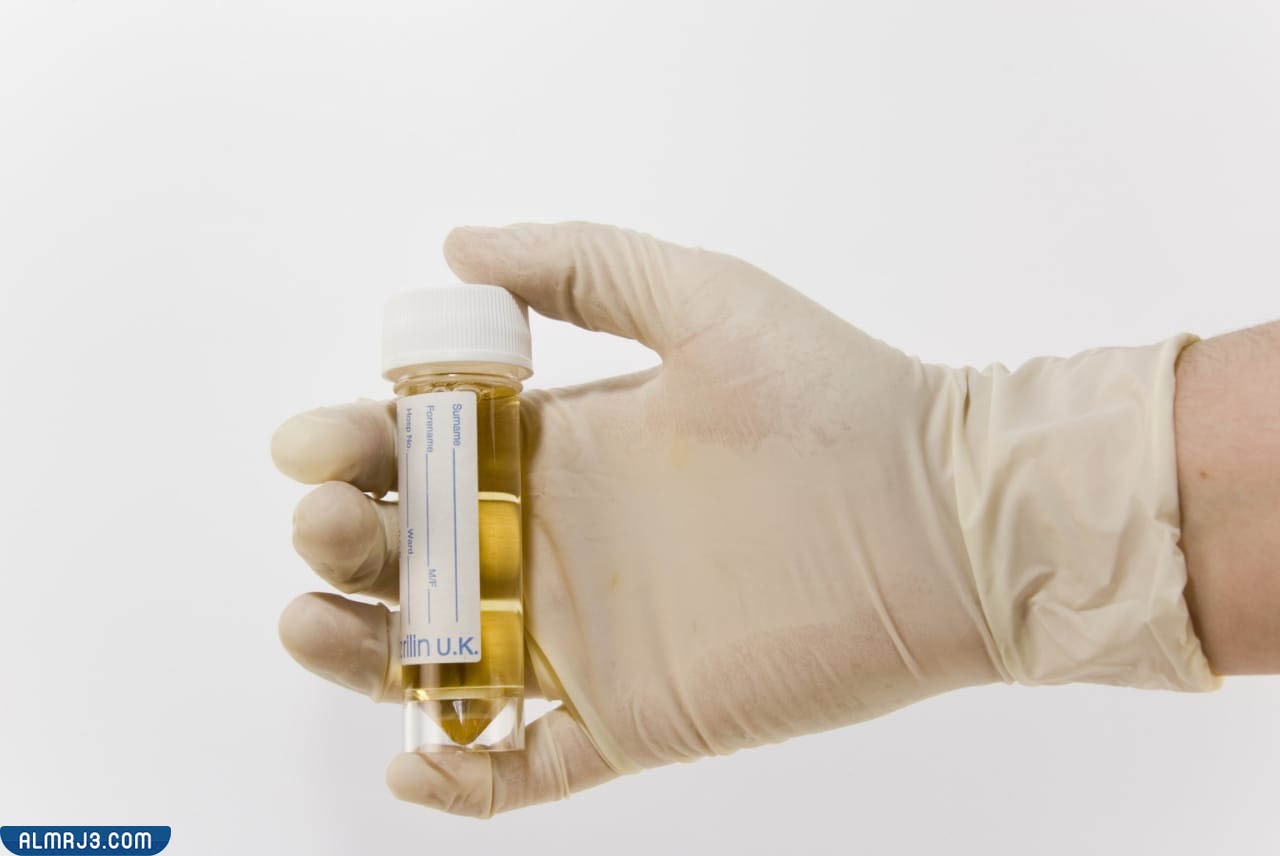 علامات تدل على التعافي من صديد البول