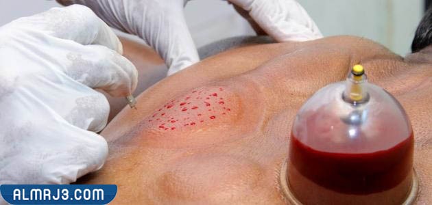 فوران الدم حسب نوع الحجامة