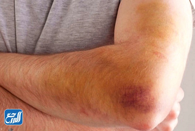 ما سبب ظهور اللون الاصفر في اثناء شفاء الكدم