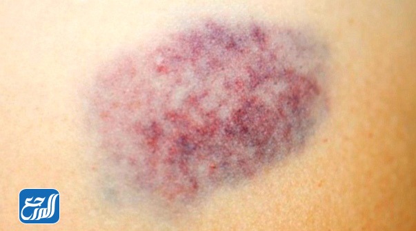 ما هي الكدمات وأسباب ظهورها