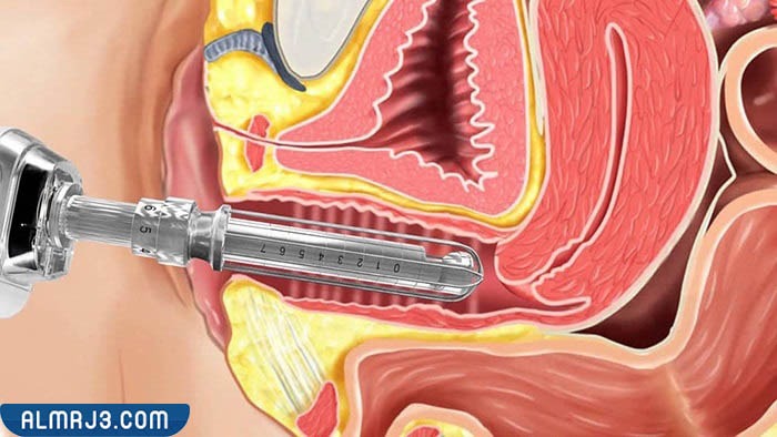 مزايا الفيلر لمنطقة البكيني