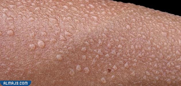 هل التعرق من علامات الشفاء من الإنفلونزا