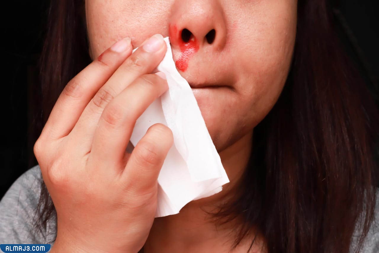 نصائح للتعامل مع نزيف الأنف من فتحتين