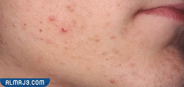 نصائح للوقاية من حبوب الوجه الصغيرة