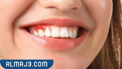 أسباب التهاب اللثة