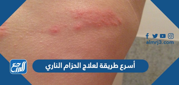 أسرع طريقة لعلاج الحزام الناري