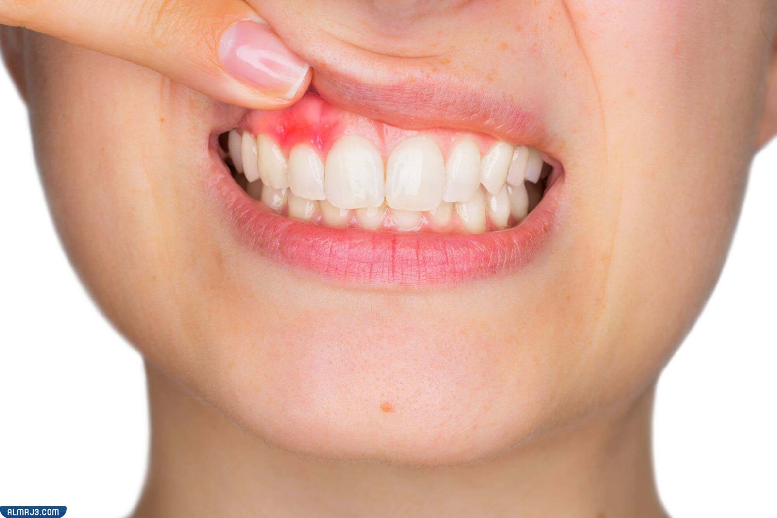 أعراض التهاب اللثة