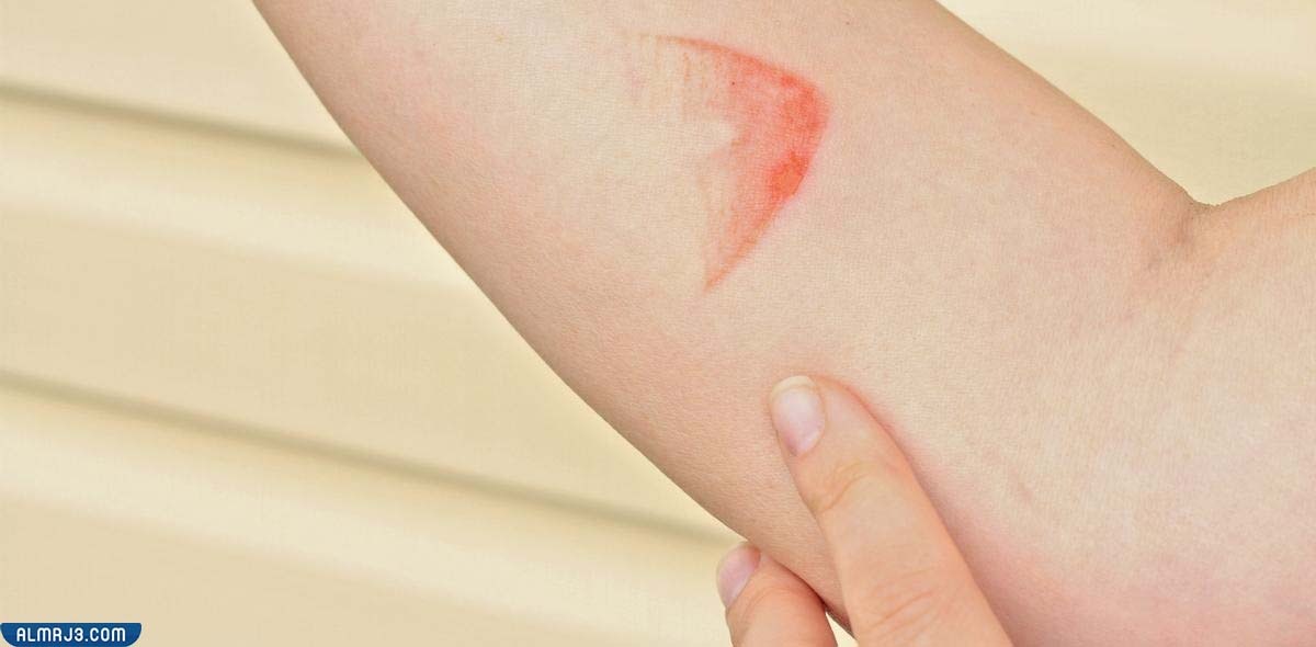 أعراض حروق المكواة