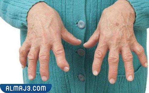 أعراض الإصابة بمرض الروماتويد