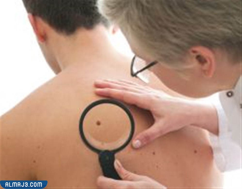 أنواع الشامات