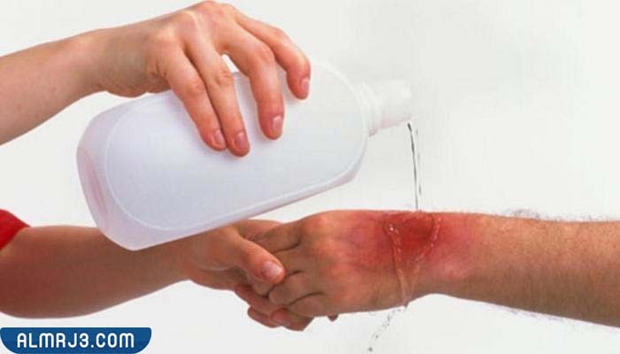 الاسعافات الاولية لعلاج حروق المكواة