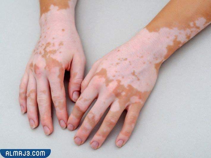 تشخيص مرض البهاق