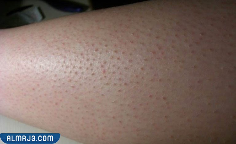 تجربتي مع جلد الدجاجة