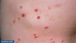 أسرع طريقة لعلاج الحزام الناري