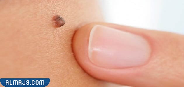 طرق الوقاية من حبوب الخال 