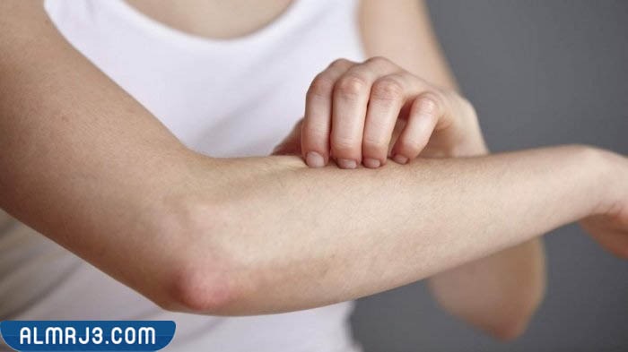 طرق طبية لعلاج جلد الدجاجة