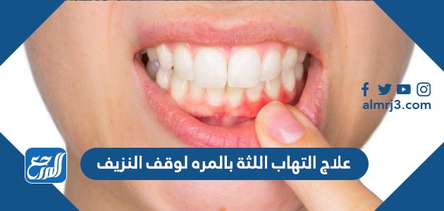 علاج التهاب اللثة بالمره لوقف النزيف