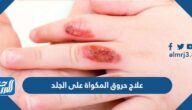 علاج حروق المكواة على الجلد بطرق مجربة