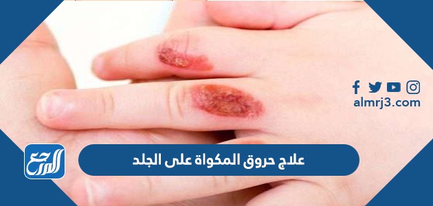 علاج حروق المكواة على الجلد