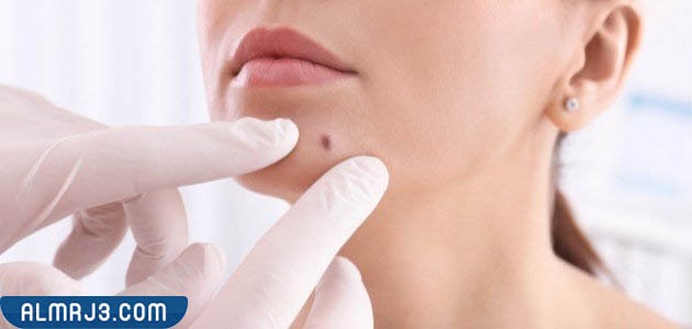 عوامل تزيد من خطر الإصابة بحبوب الخال