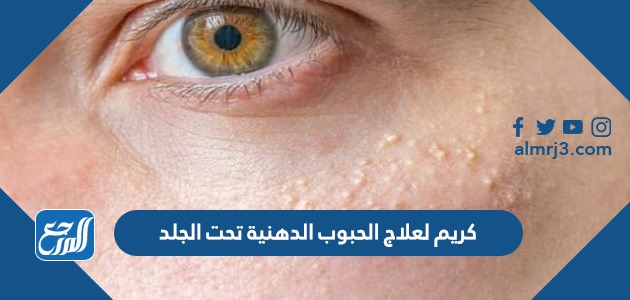 كريم لعلاج الحبوب الدهنية تحت الجلد