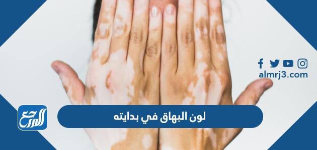 لون البهاق في بدايته