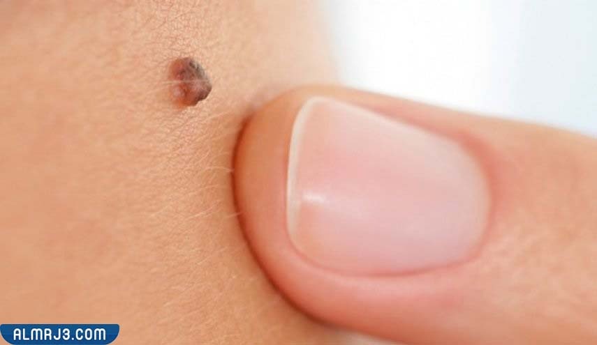 ما هي الشامة