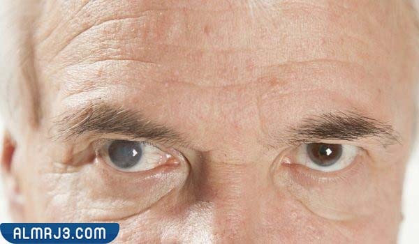 نصائح للوقاية من المياه البيضاء