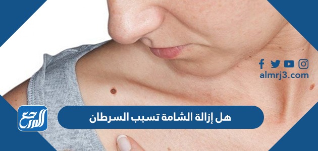 هل إزالة الشامة تسبب السرطان