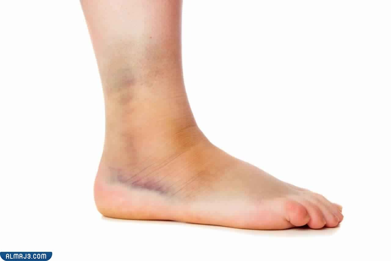 أعراض تورم الساق بعد السقوط