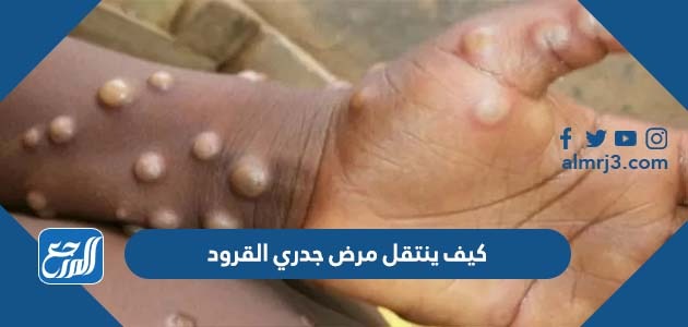 كيف ينتقل مرض جدري القرود