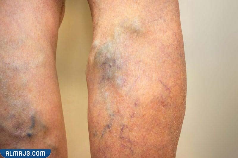 أسباب ظهور الدوالي